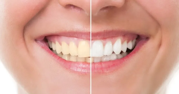 Dişlerde renk değişimine dikkat! İşte dişlerde renk değişiminin sebepleri...