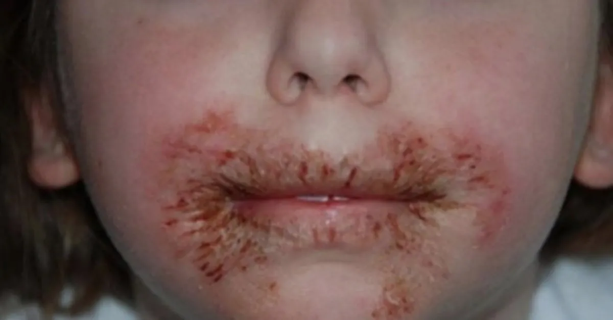 8 Yasindaki Kizinin Yuzunde Ciddi Yaralar Cikiyordu Doktor Annenin Arastirmasinin Sonucu Korkunc Oldu Son Dakika Haberler