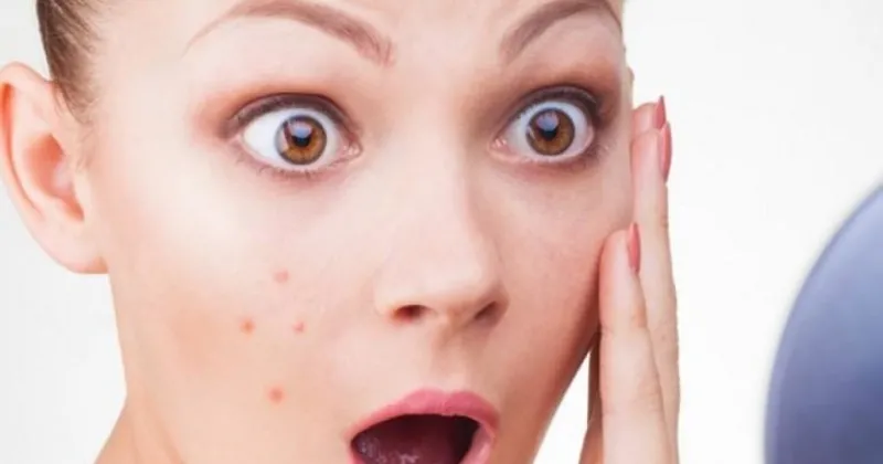 Sivilce Patlatmak Zararli Mi Sivilceye Ne Iyi Gelir Saglik Haberleri Sivilce Patlatmak Zararli Mi Sivilceye Ne Iyi Gelir Saglik Haberleri