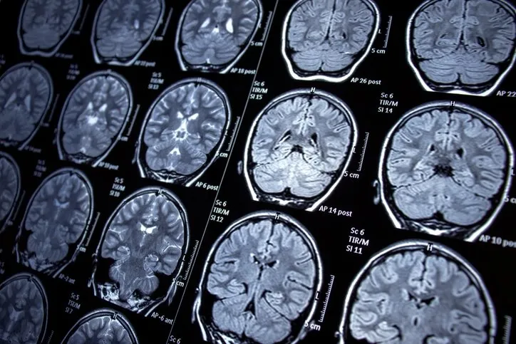 Beyninde 8 yıl boyunca sinsice uzamış! Cerrahları şoke eden vaka: 3 metre uzunluğunda...