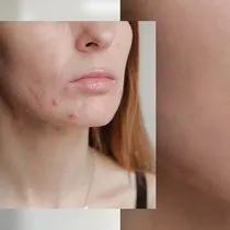 bebeklerin yuzundeki sivilce gibi kizariklik nasil gecer bebeklerin yuzunde cikan sivilceler neden olur bebek haberleri