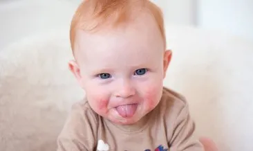 Bebeklerde ağız içi aft ile dil yarası nasıl geçer, tedavisi var mı? Bebeklerde ağız yarasına ne iyi gelir?