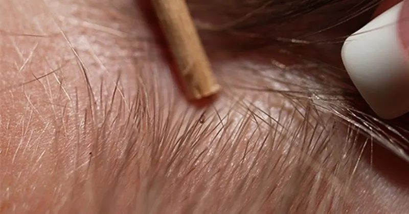 bit nasil temizlenir bitten