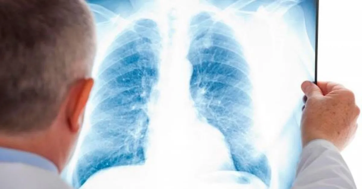 akcigerde leke neyin belirtisidir akcigerde leke neden olur nasil gecer saglik haberleri akcigerde leke neyin belirtisidir akcigerde leke neden olur nasil gecer saglik haberleri