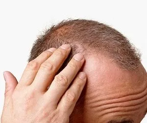 Saç dökülmesi,  nedenleri ve tedavisi