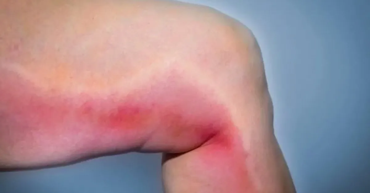 Pihti Atmasi Neden Olur Pihti Atmasinin Tedavisi Nasil Yapilir Saglik Haberleri