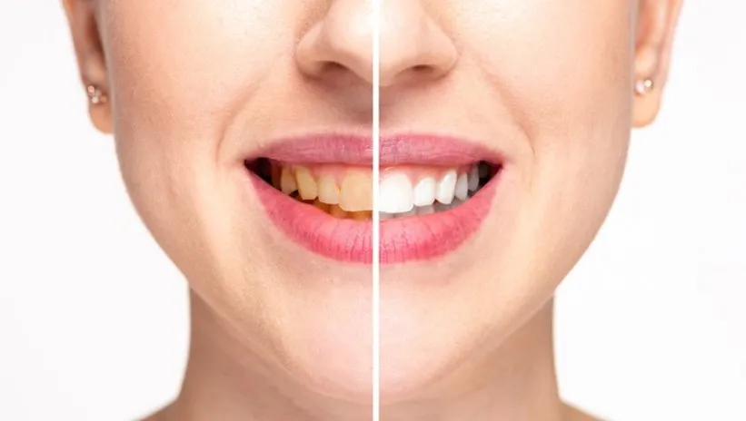 Dişlerin rengini 3 ton açıyor! Bembeyaz gülüşün sırrı bu malzemede…