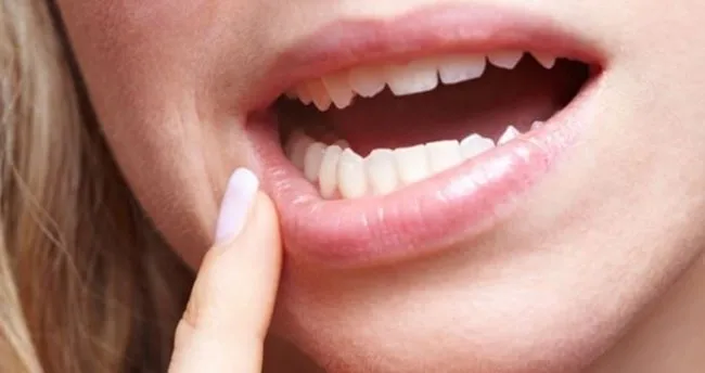 Agiz Yarasi Hangi Vitamin Eksikliginden Olur Aft Bulasici Mi Krem Tedavisi Nasil Yapilir Saglik Haberleri