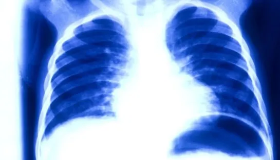 Astım bronşitin belirtileri ve tedavisi!