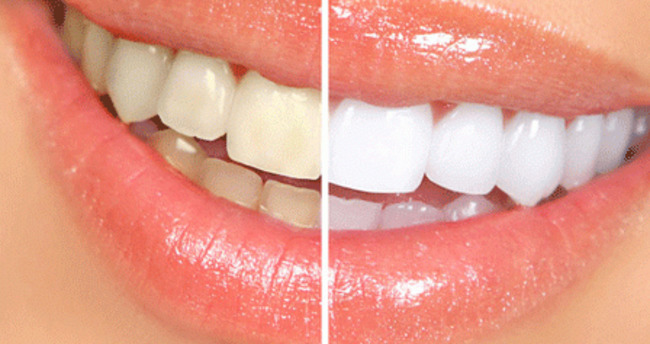 Dişlerimiz neden sararır?