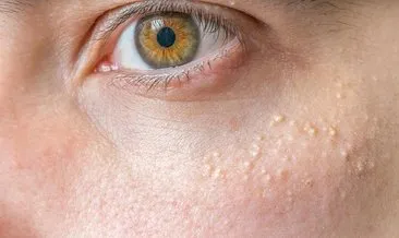 goz cevresindeki beyaz noktalar nedir nasil gecer saglik haberleri