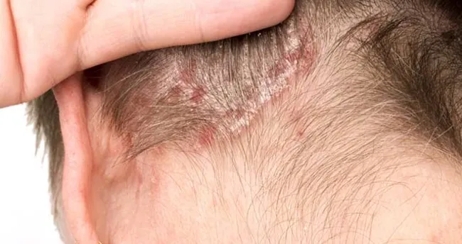 Saç derisinde kabuklanma neden olur? - Sağlık Haberleri