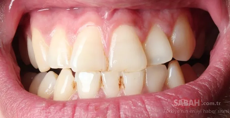 bu yontemleri uygulayarak dis