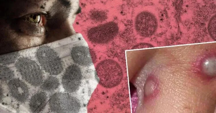 Çiçek aşısı yüzde 85 koruma sağlar