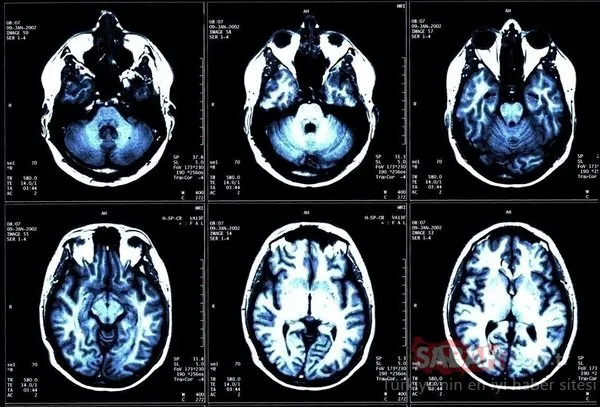 Beyin tümörünün habercisi... Bu sinyallere dikkat edin!