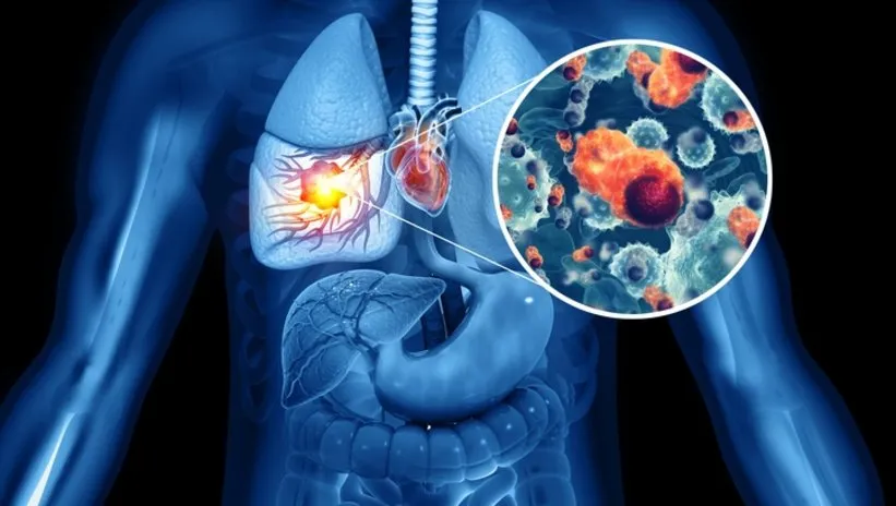 İki haftayı geçen öksürüklerin akciğer kanseri belirtisi olabileceği uyarısı