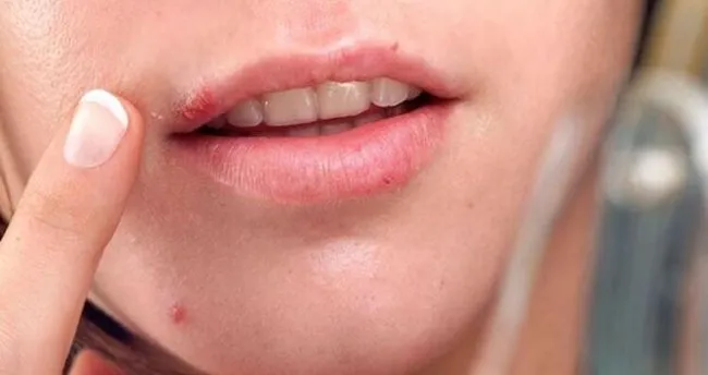 ucuga ne iyi gelir ucuga ne surulur dogal ve bitkisel cozum yontemleriyle ucuk nasil gecer evde kesin cozum saglik haberleri