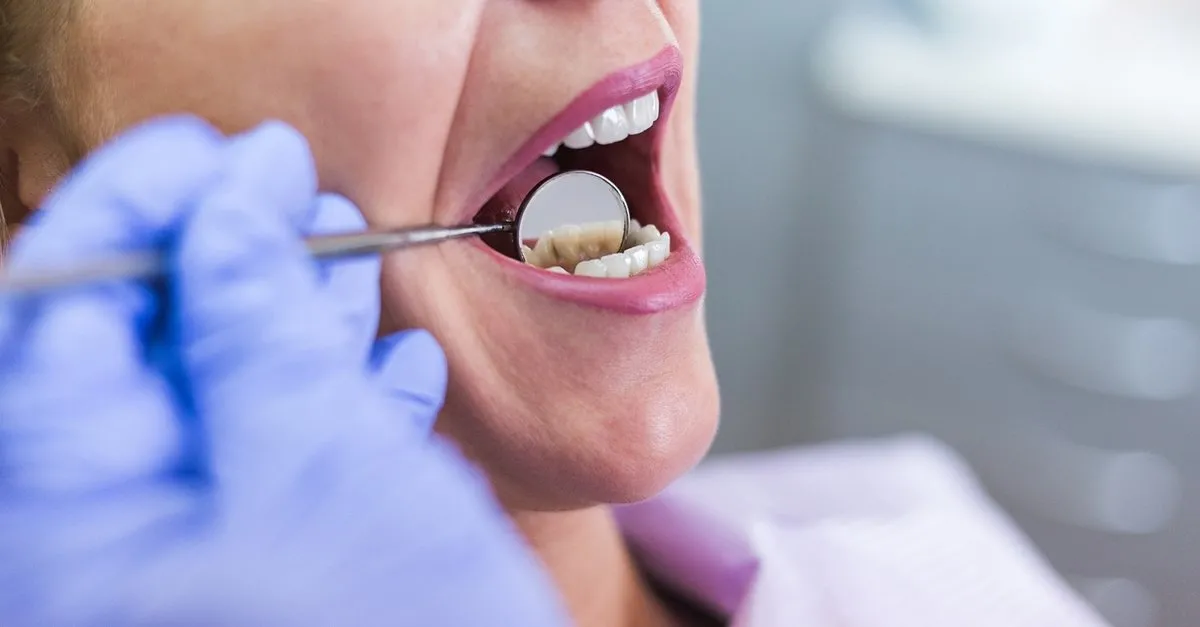 dis temizleme ve beyazlatma onerileri