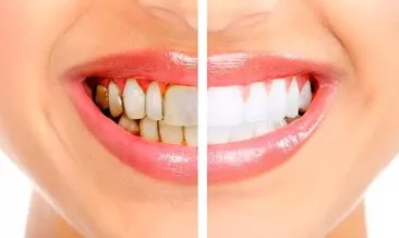 Diş Taşı Temizliği Nasıl Yapılır? Evde Diş Taşı Nasıl Temizlenir Ve Nasıl Önlenir?