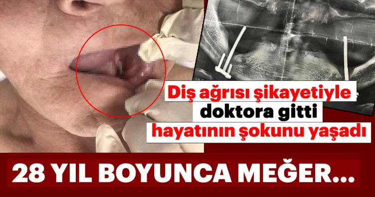 Diş ağrısı şikayetiyle doktora gitti hayatının şokunu yaşadı! 28 yıl boyunca ağzında vida taşımış