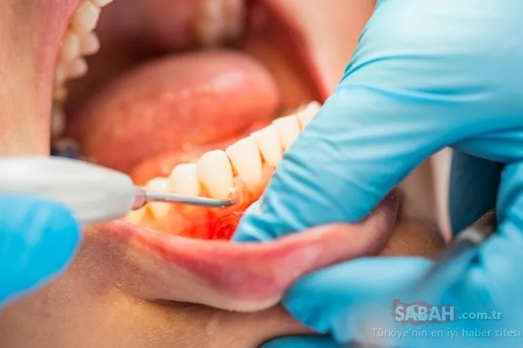 Bu yöntemleri uygulayarak diş taşlarınızdan kurtulun!
