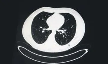 Aşılı ve aşısız farkı akciğer tomografisinde ortaya çıktı