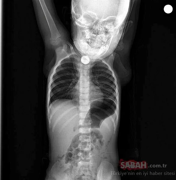 1,5 yaşındaki Berfin’in yuttuğu pil operasyonla alındı