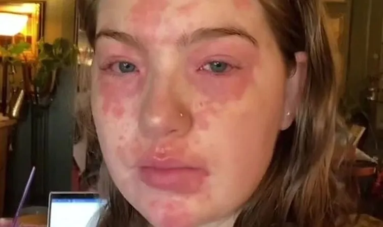 Erkek arkadaşına alerjisi olan kadın sosyal medyada viral oldu! Ne zaman birlikte olsak...
