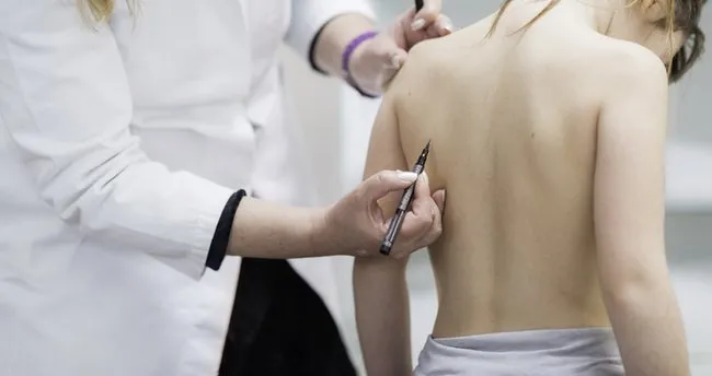 omurga egriligi belirtileri nelerdir