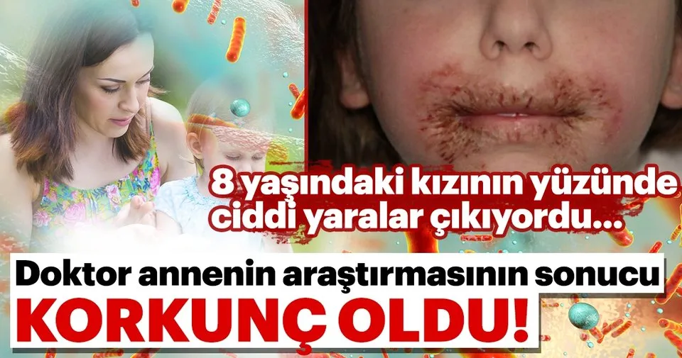 8 Yasindaki Kizinin Yuzunde Ciddi Yaralar Cikiyordu Doktor Annenin Arastirmasinin Sonucu Korkunc Oldu Son Dakika Haberler