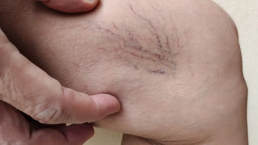 VARİS DEYİP GEÇMEYİN! ANİ ÖLÜMLERE NEDEN OLABİLİYOR...