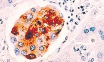 Kansere karşı şeker bombası