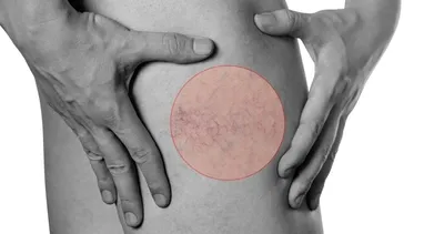 Uzun süre hareketsiz kalmak varise neden oluyor! İşte varis belirtileri...