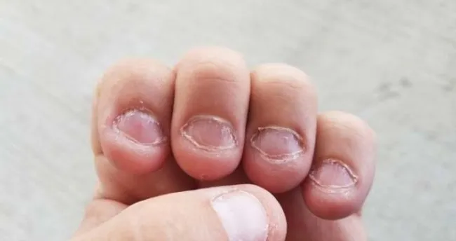 Tirnak Yeme Aliskanligi Nasil Birakilir Son Dakika Haberler