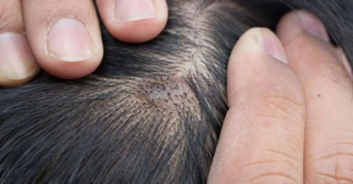 Sac Dipleri Neden Kasinir Sac Derisinde Meydana Gelen Yara Ve Kasinti Nasil Gecer Son Dakika Yasam Haberleri