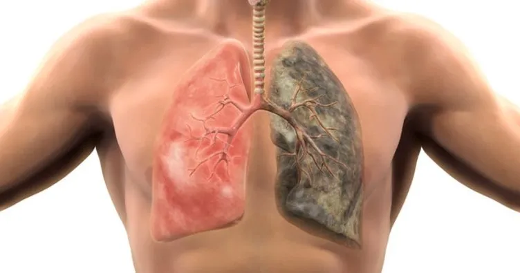 Akciğer kanserinin yüzde 90’ı sigaradan