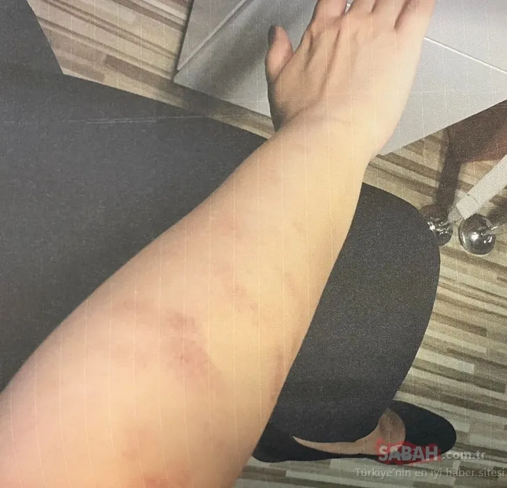 Ünlü şair Ahmet Selçuk İlkan’ın kızları lazer mağduruydu! O davada yeni gelişme!