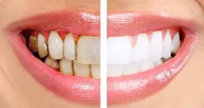 Diş çürüklerine karşı tam bir kalkan!