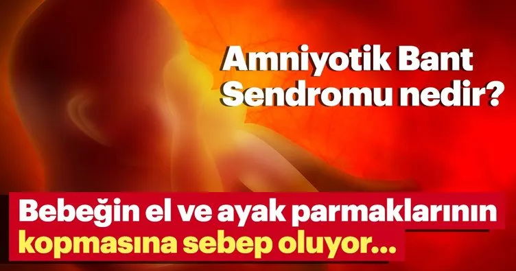 Amniyotik Bant Amniotic Band Sendromu Nedir Tedavisi Var Mi Saglik Haberleri Amniyotik Bant Amniotic Band Sendromu Nedir Tedavisi Var Mi Saglik Haberleri