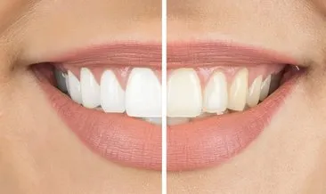Beyaz diş isterken tüm dişlerinizden olmayın! Uzmanı uyardı: Sakın denemeyin...