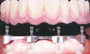 İmplant tedavisinin riskleri nelerdir?