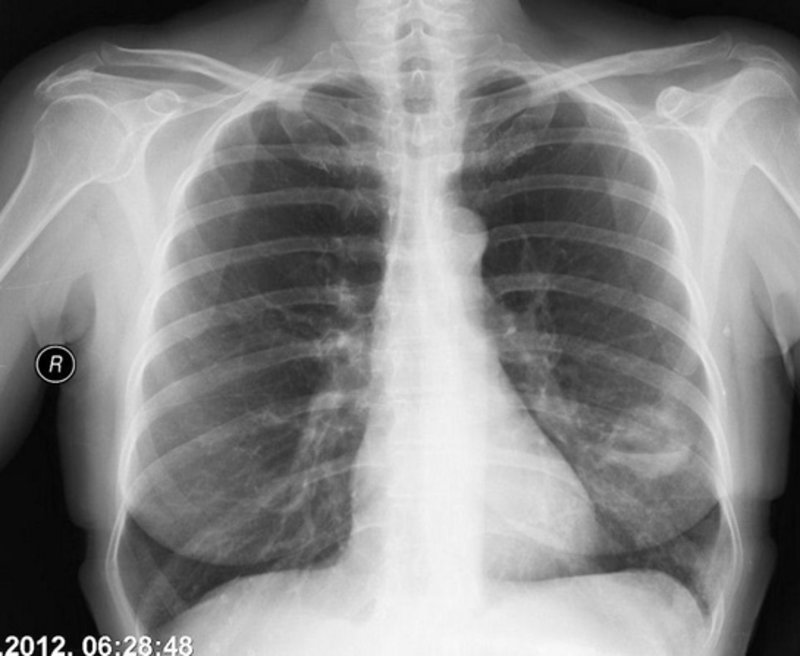 Akciger Kisti Kist Hidatik Belirtileri Ve Tedavisi Saglik Haberleri