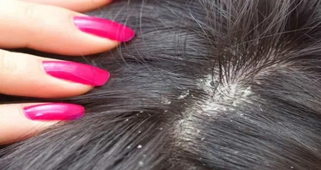 kepek neden olusur kepekten kurtulmak icin bitkisel cozum yollari son dakika haberler