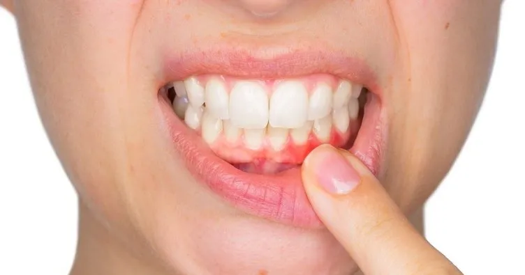 Diş Eti İltihabına Ne İyi Gelir? Antibiyotikle Geçmeyen Diş Eti İltihabı Nasıl Geçer, Belirtileri ve Evde Tedavisi Nedir?