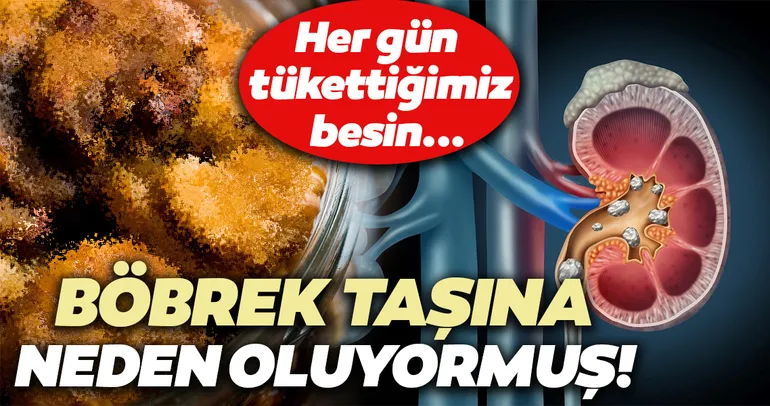 Bu gıdaya dikkat! Böbrek taşına neden olduğu ortaya çıktı