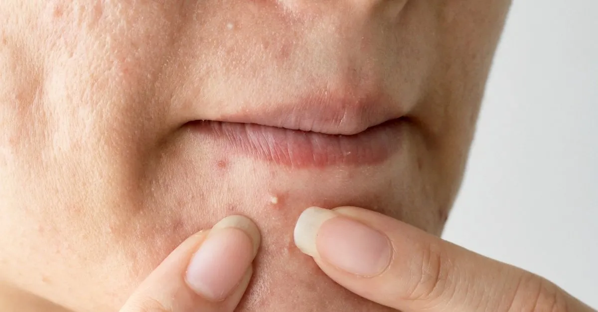 Cilt Deri Kanseri Nedir Cilt Deri Kanseri Belirtileri Nelerdir Saglik Haberleri