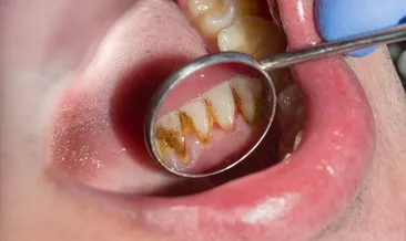 Diş taşı diş kaybına neden olabilir!