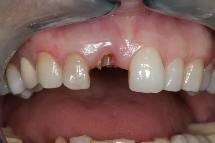 Diş eksikliği birçok hastalığa davetiye çıkarıyor