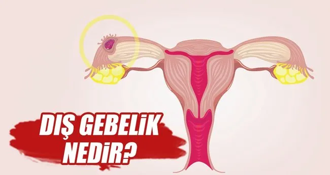 dis gebelik nedir dis gebelik nasil olusur saglik haberleri