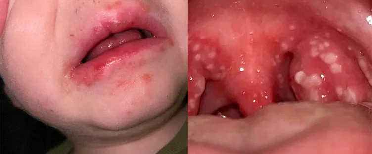 Strep A İngiltere’yi esir aldı: Çocukları hastalıkla boğuşan anne anlattı: Strep A böyle başlıyor...